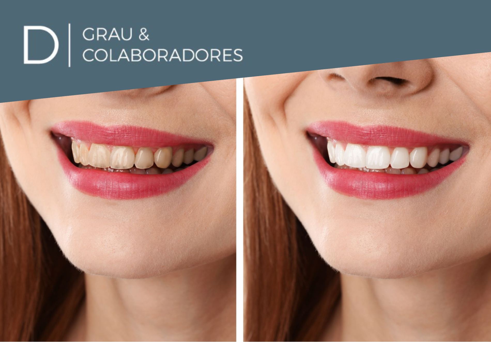 Blanqueamiento dental